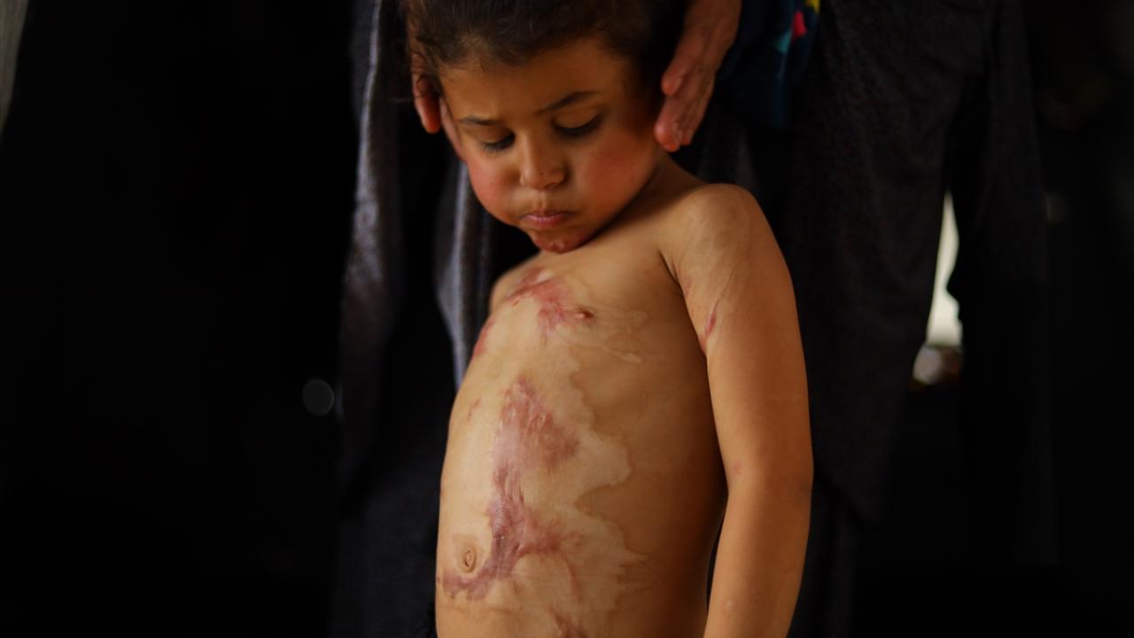 Gazze'de İnsanlık Dramı! İsrail'in Zulmü Yanık Hastalarını Ölüme Terk Ediyor!